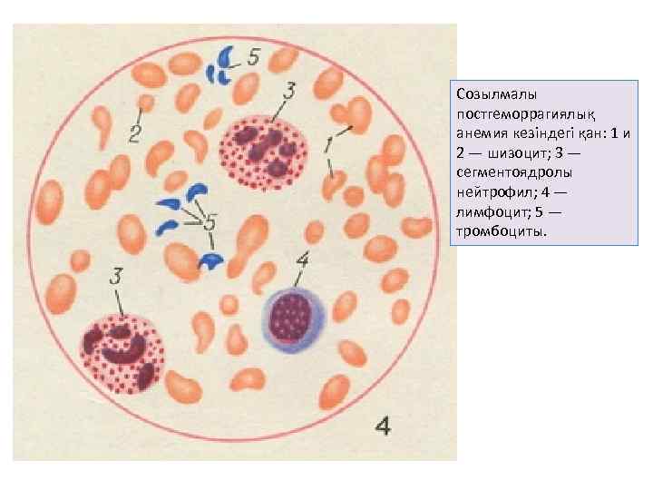 Созылмалы постгеморрагиялық анемия кезіндегі қан: 1 и 2 — шизоцит; 3 — сегментоядролы нейтрофил;