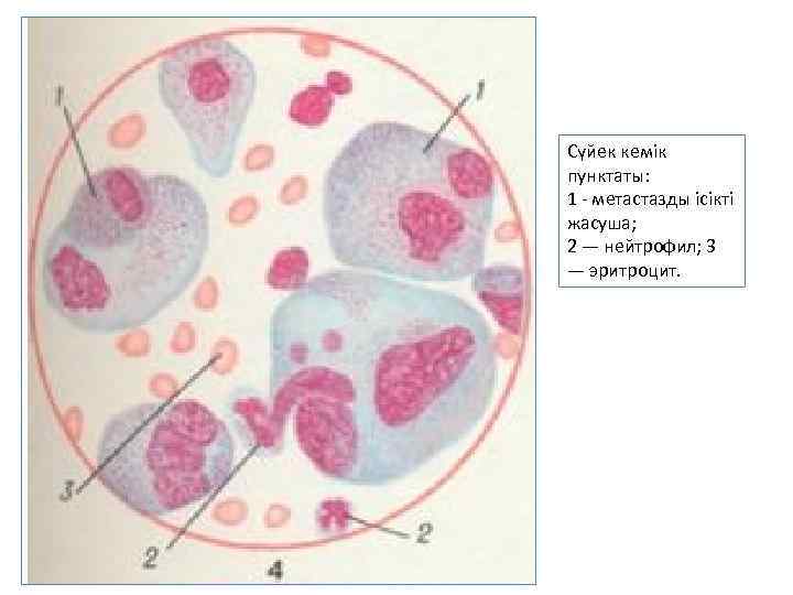 Сүйек кемік пунктаты: 1 - метастазды ісікті жасуша; 2 — нейтрофил; 3 — эритроцит.