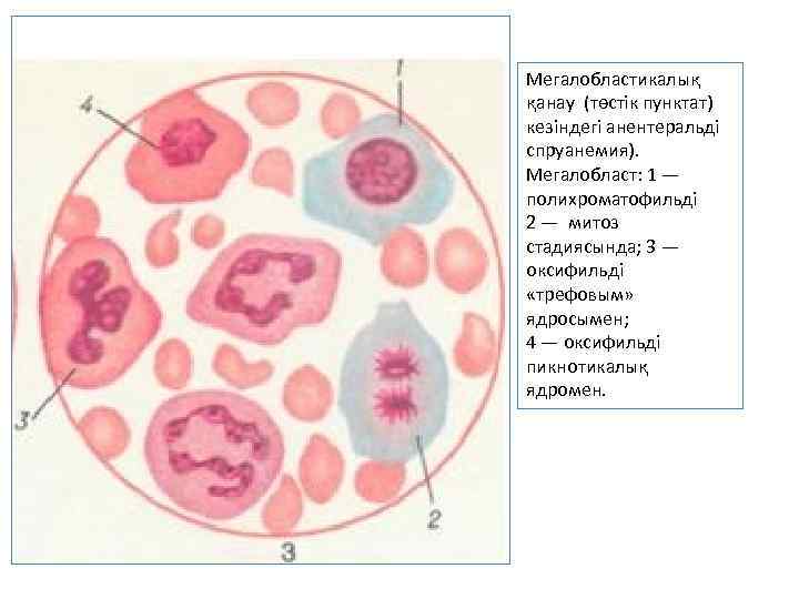 Мегалобластикалық қанау (төстік пунктат) кезіндегі анентеральді спруанемия). Мегалобласт: 1 — полихроматофильді 2 — митоз