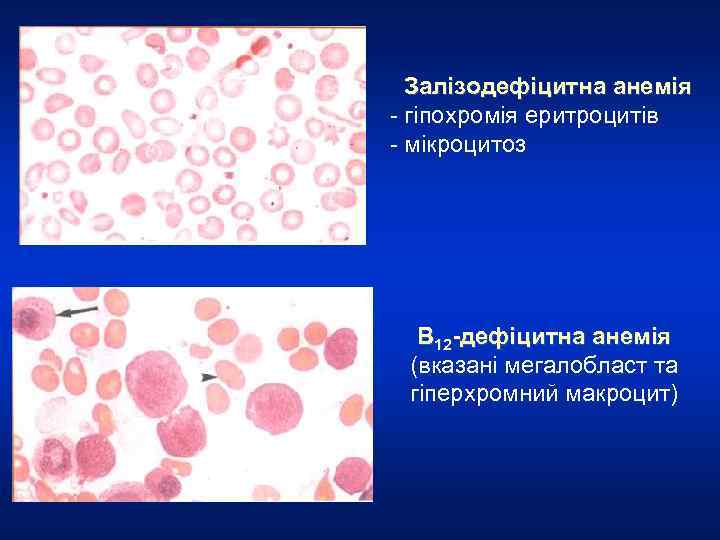 Залізодефіцитна анемія - гіпохромія еритроцитів - мікроцитоз В 12 -дефіцитна анемія (вказані мегалобласт та