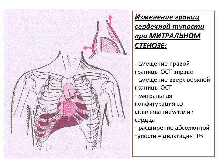 Изменение границ сердечной тупости при МИТРАЛЬНОМ СТЕНОЗЕ: - смещение правой границы ОСТ вправо -