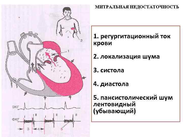 МИТРАЛЬНАЯ НЕДОСТАТОЧНОСТЬ 1. регургитационный ток крови 2. локализация шума 3. систола 4. диастола 5.