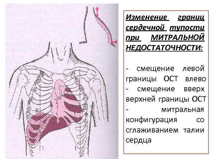 Изменение границ сердечной тупости при МИТРАЛЬНОЙ НЕДОСТАТОЧНОСТИ: - смещение левой границы ОСТ влево -