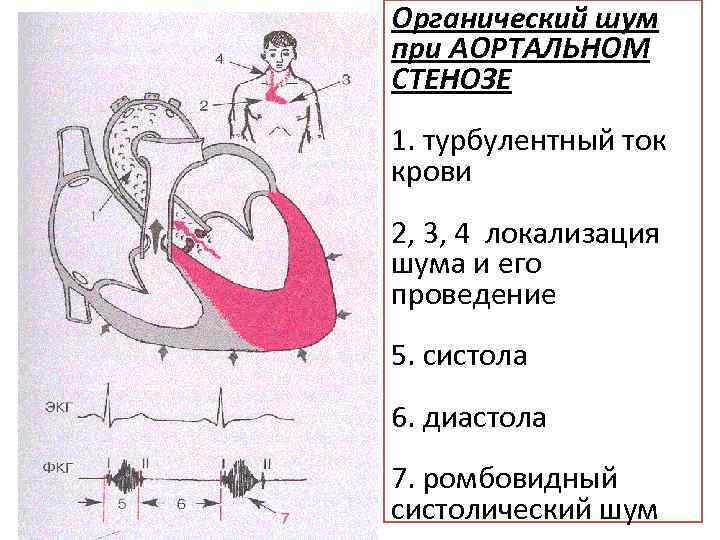 Органический шум при АОРТАЛЬНОМ СТЕНОЗЕ 1. турбулентный ток крови 2, 3, 4 локализация шума