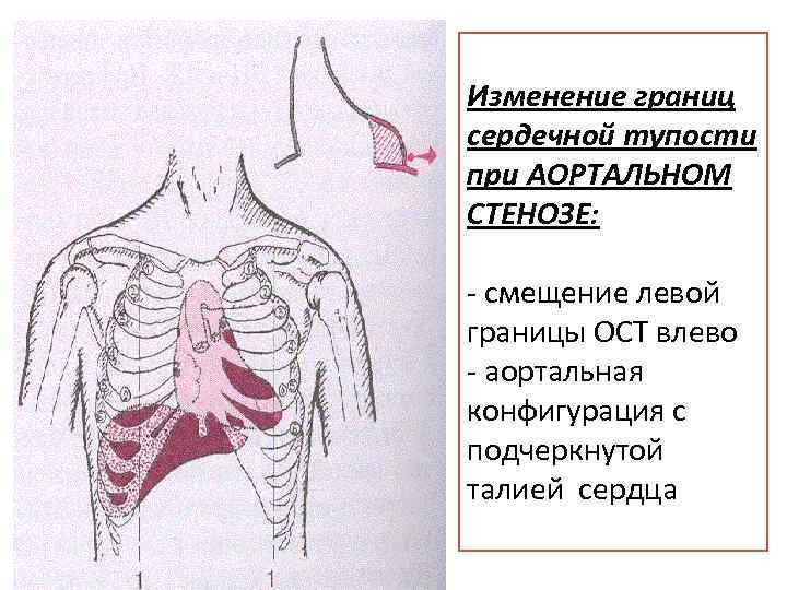 Изменение границ сердечной тупости при АОРТАЛЬНОМ СТЕНОЗЕ: - смещение левой границы ОСТ влево -