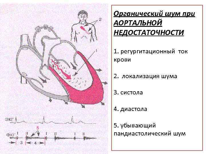 Органический шум при АОРТАЛЬНОЙ НЕДОСТАТОЧНОСТИ 1. регургитационный ток крови 2. локализация шума 3. систола