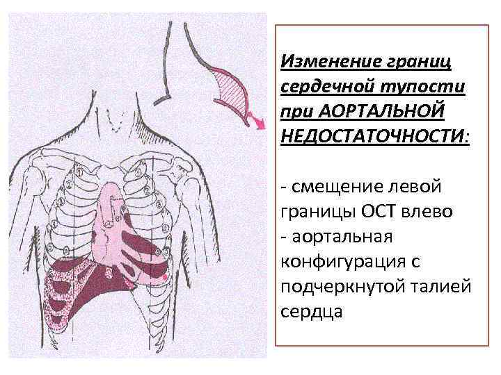 Изменение границ сердечной тупости при АОРТАЛЬНОЙ НЕДОСТАТОЧНОСТИ: - смещение левой границы ОСТ влево -