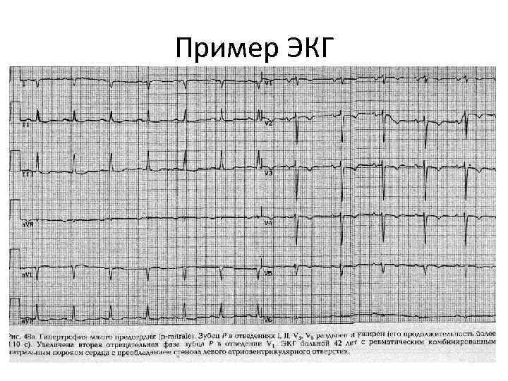 Ниже представлена фотография фрагмента электрокардиограммы и увеличенный снимок одного из сердечных