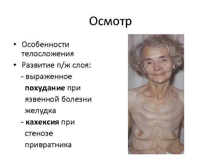 Осмотр • Особенности телосложения • Развитие п/ж слоя: выраженное похудание при язвенной болезни желудка