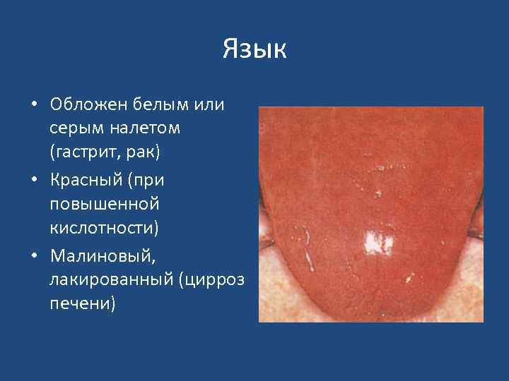 Язык • Обложен белым или серым налетом (гастрит, рак) • Красный (при повышенной кислотности)