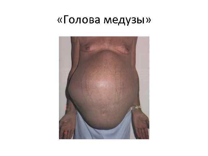  «Голова медузы» 