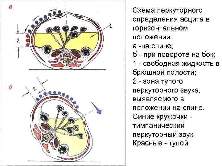 Схема перкуторного определения асцита в горизонтальном положении: а -на спине; б - при повороте
