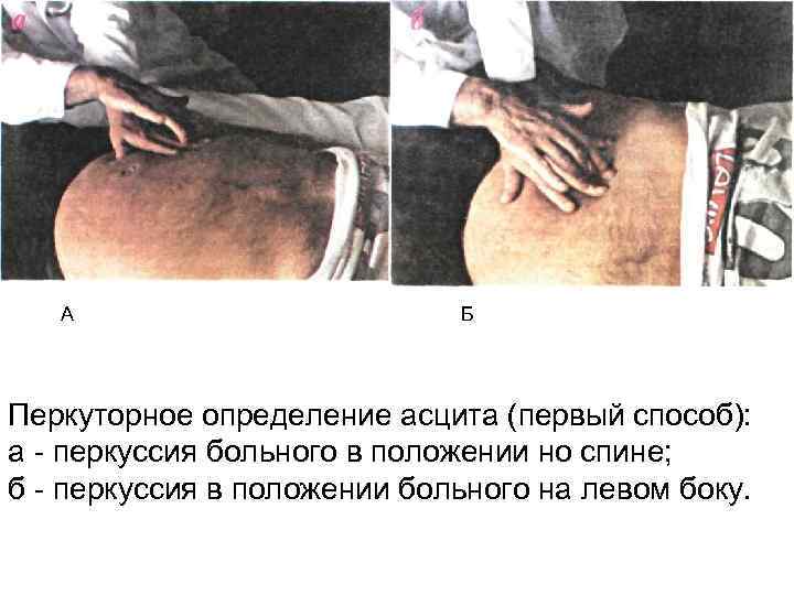 А Б Перкуторное определение асцита (первый способ): а - перкуссия больного в положении но