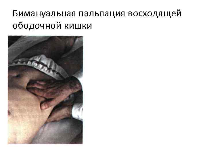 Бимануальная пальпация восходящей ободочной кишки 