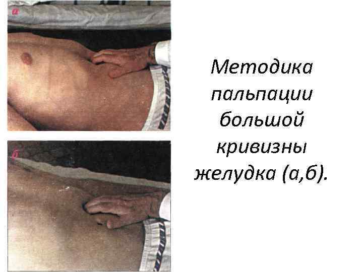 Методика пальпации большой кривизны желудка (а, б). 