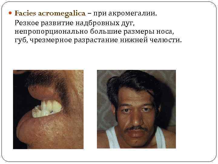  Facies acromegalica – при акромегалии. Резкое развитие надбровных дуг, непропорционально большие размеры носа,