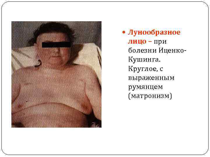  Лунообразное лицо – при болезни Иценко. Кушинга. Круглое, с выраженным румянцем (матронизм) 