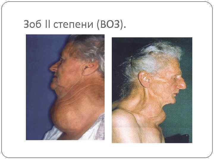 Зоб II степени (ВОЗ). 