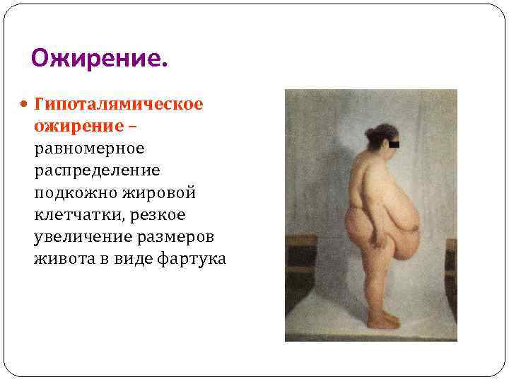 Ожирение. Гипоталямическое ожирение – равномерное распределение подкожно жировой клетчатки, резкое увеличение размеров живота в