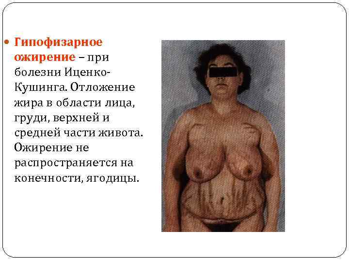  Гипофизарное ожирение – при болезни Иценко. Кушинга. Отложение жира в области лица, груди,