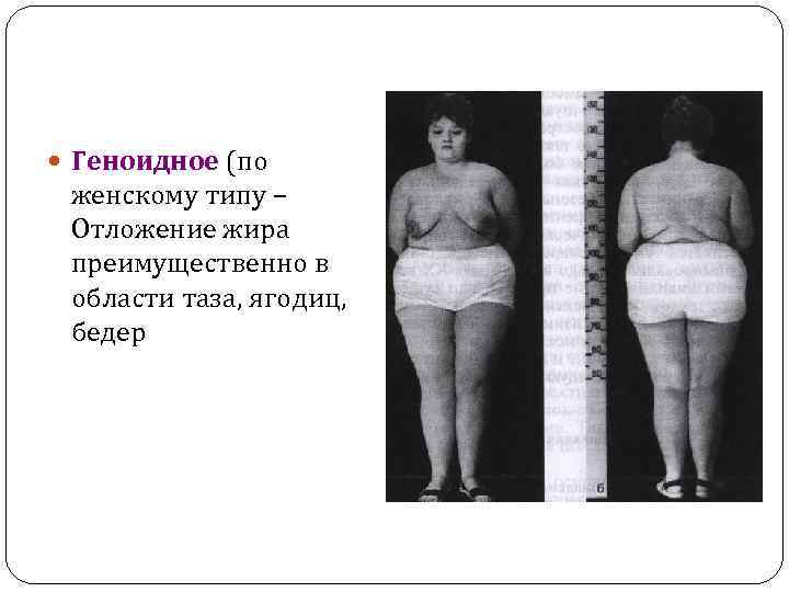  Геноидное (по женскому типу – Отложение жира преимущественно в области таза, ягодиц, бедер