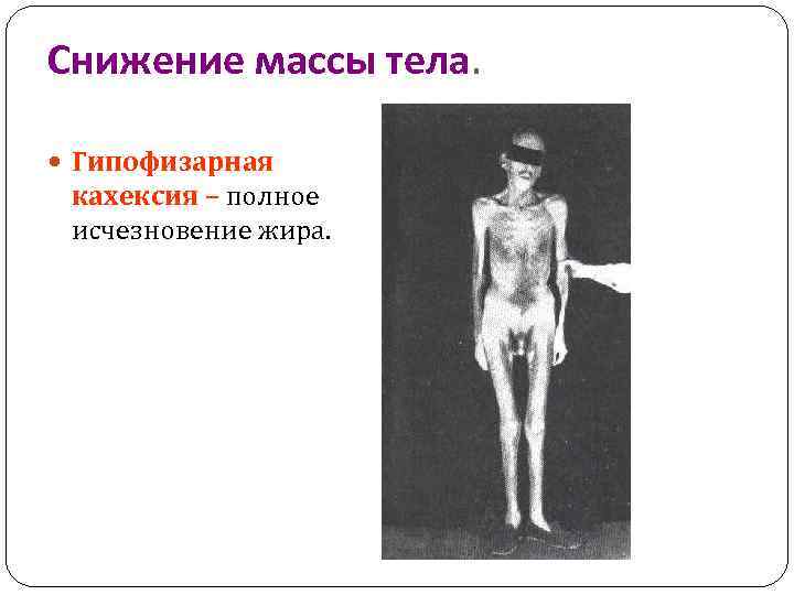 Снижение массы тела. Гипофизарная кахексия – полное исчезновение жира. 