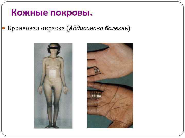 Кожные покровы. Бронзовая окраска (Аддисонова болезнь) 