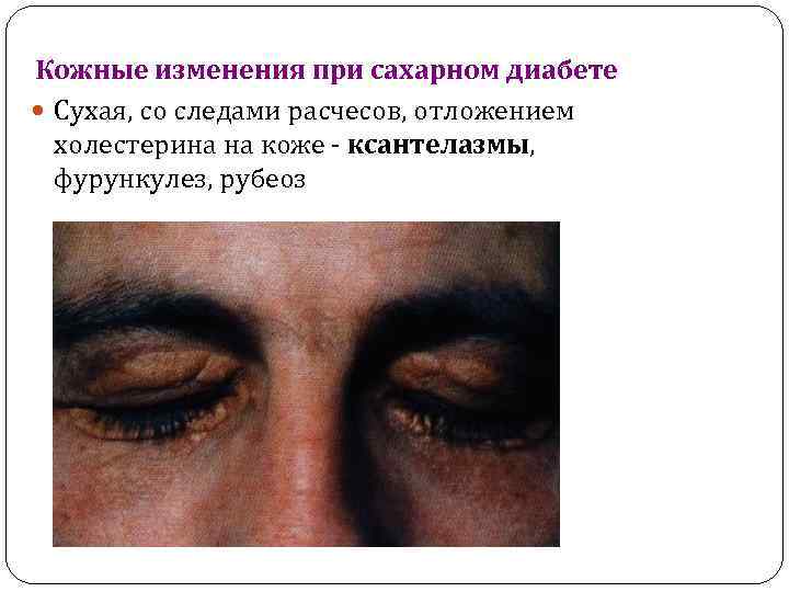 Кожные изменения при сахарном диабете Сухая, со следами расчесов, отложением холестерина на коже -