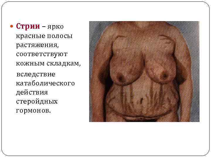  Стрии – ярко красные полосы растяжения, соответствуют кожным складкам, вследствие катаболического действия стеройдных
