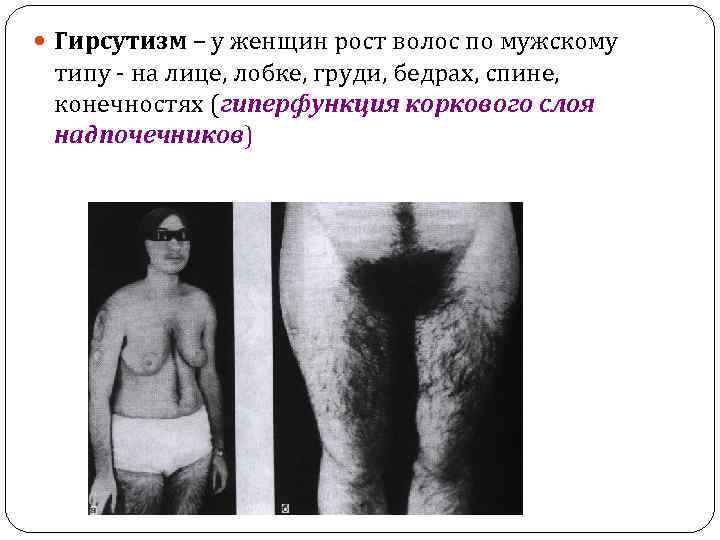  Гирсутизм – у женщин рост волос по мужскому типу - на лице, лобке,