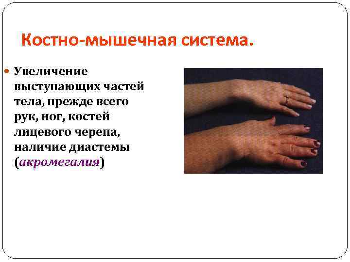 Костно-мышечная система. Увеличение выступающих частей тела, прежде всего рук, ног, костей лицевого черепа, наличие