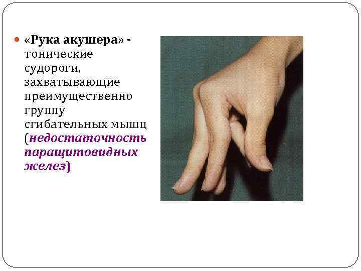  «Рука акушера» - тонические судороги, захватывающие преимущественно группу сгибательных мышц (недостаточность паращитовидных желез)