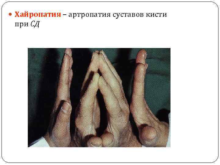  Хайропатия – артропатия суставов кисти при СД 