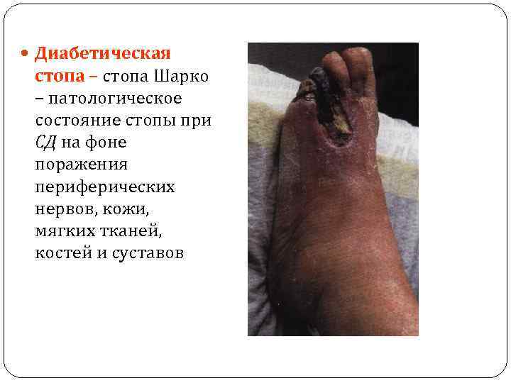  Диабетическая стопа – стопа Шарко – патологическое состояние стопы при СД на фоне