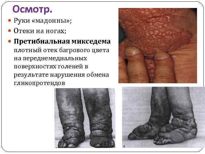 Осмотр. Руки «мадонны» ; Отеки на ногах; Претибиальная микседема плотный отек багрового цвета на