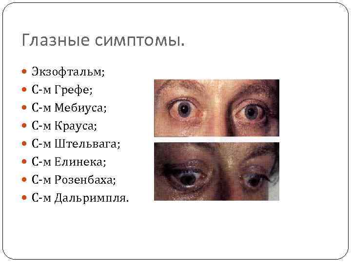 Глазные симптомы. Экзофтальм; С-м Грефе; С-м Мебиуса; С-м Крауса; С-м Штельвага; С-м Елинека; С-м
