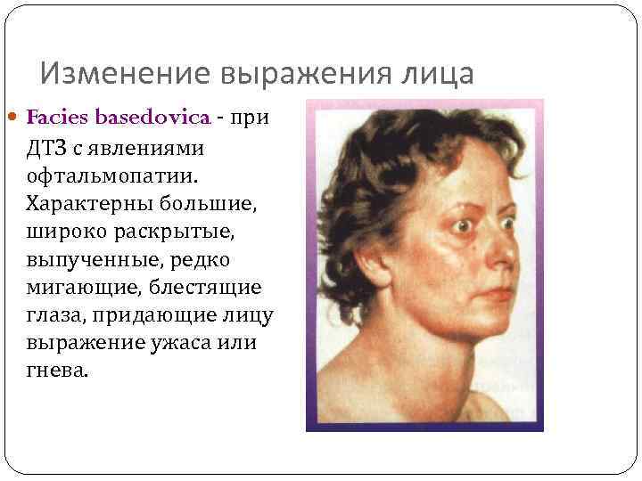 Изменение выражения лица Facies basedovica - при ДТЗ с явлениями офтальмопатии. Характерны большие, широко