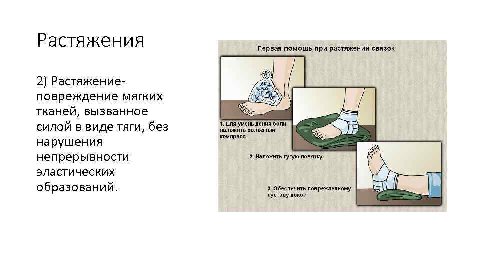 Растяжения 2) Растяжение- повреждение мягких тканей, вызванное силой в виде тяги, без нарушения непрерывности