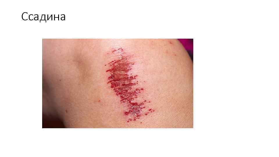 Ссадина 