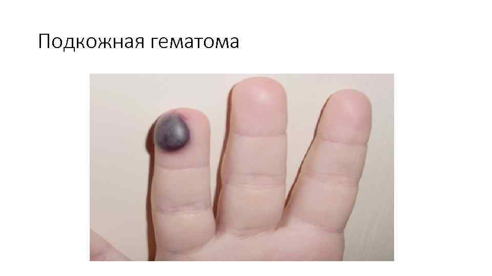 Подкожная гематома 