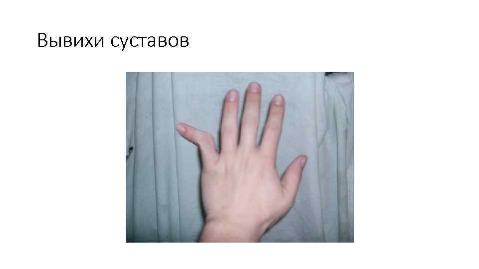 Вывихи суставов 