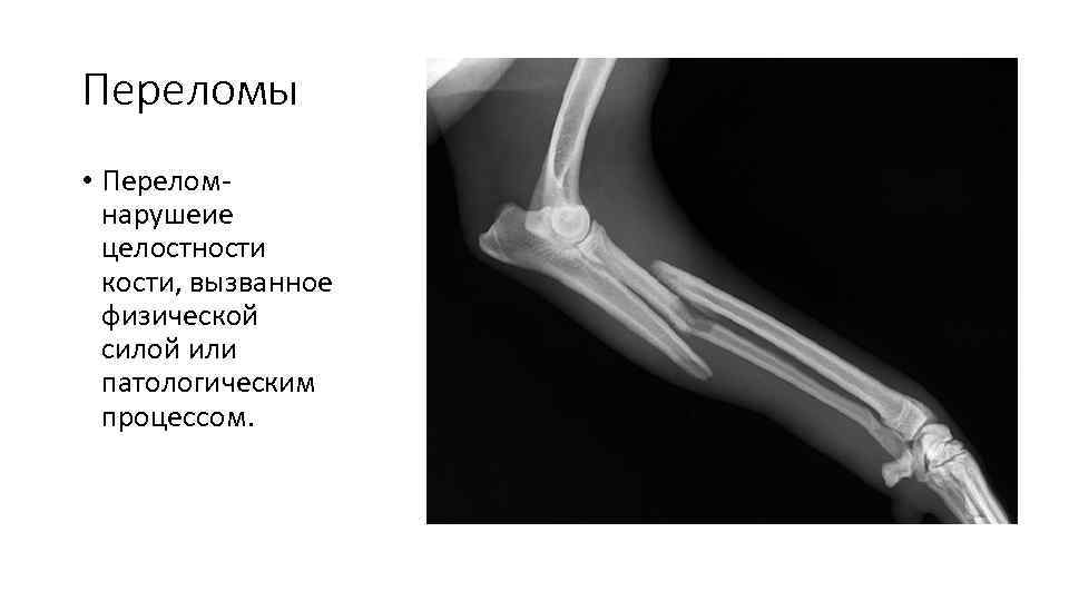 Переломы • Перелом- нарушеие целостности кости, вызванное физической силой или патологическим процессом. 