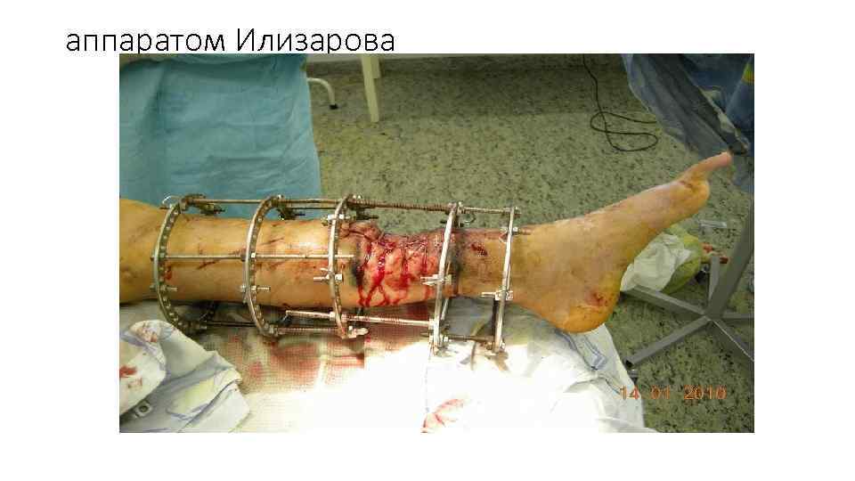 аппаратом Илизарова 
