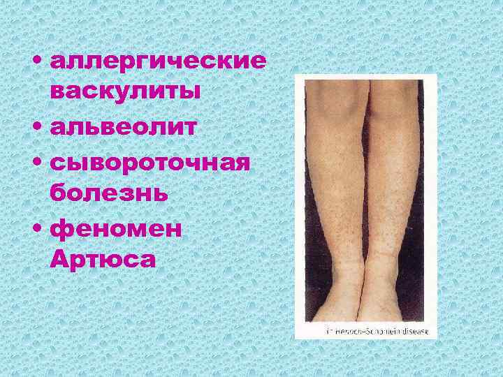  • аллергические васкулиты • альвеолит • сывороточная болезнь • феномен Артюса 