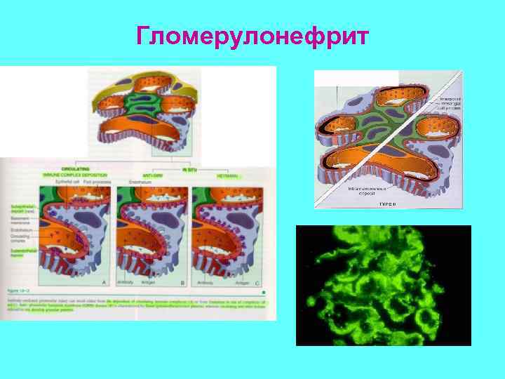 Гломерулонефрит 