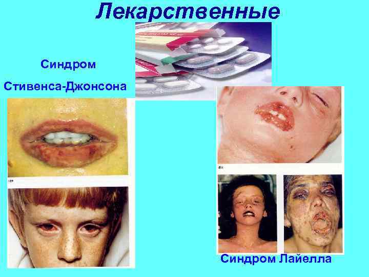 Лекарственные Синдром Стивенса-Джонсона Синдром Лайелла 