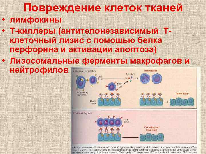 Повреждение клеток тканей • лимфокины • Т-киллеры (антителонезависимый Тклеточный лизис с помощью белка перфорина