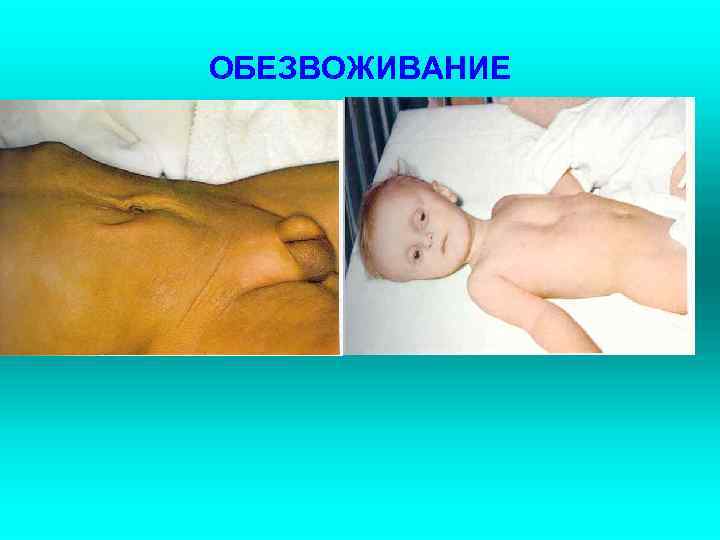 ОБЕЗВОЖИВАНИЕ 