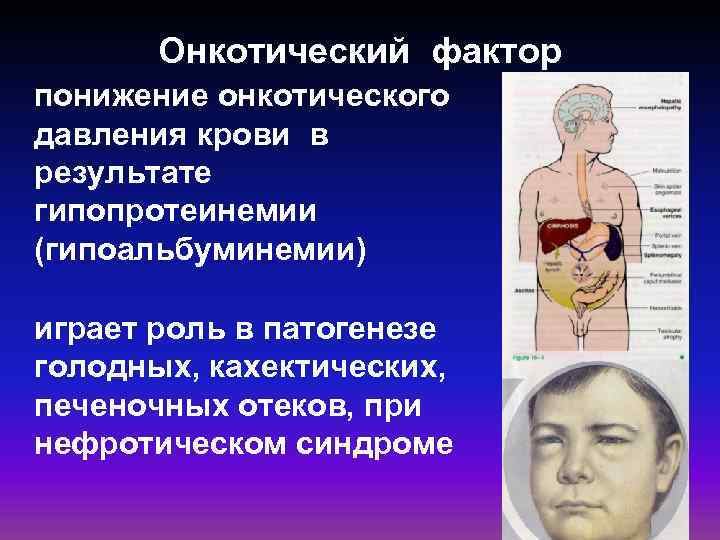 Онкотический фактор понижение онкотического давления крови в результате гипопротеинемии (гипоальбуминемии) играет роль в патогенезе