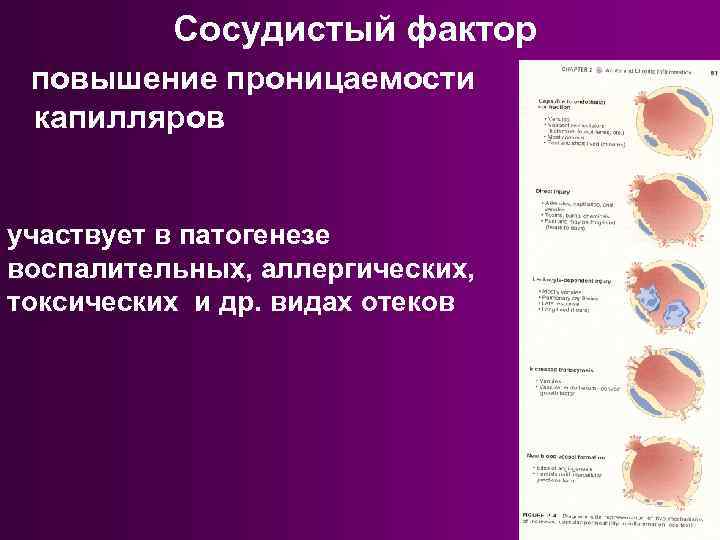 Сосудистый фактор повышение проницаемости капилляров участвует в патогенезе воспалительных, аллергических, токсических и др. видах